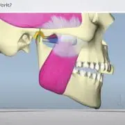 Image of TMJ for Dawson Academy webinar titled TMJ 101